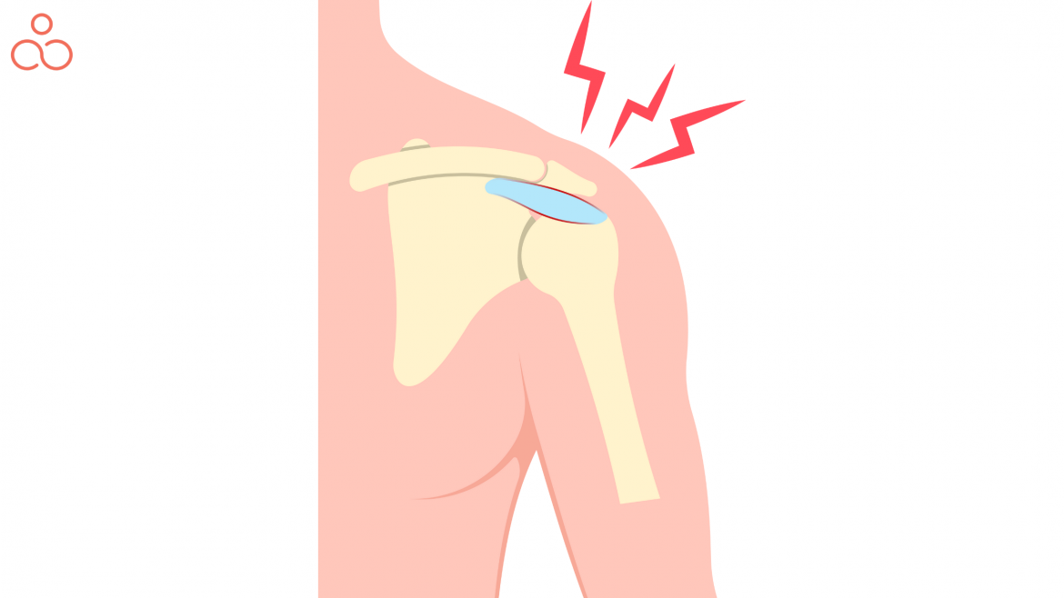 All About Shoulder Impingement and How Can Yoga for Shoulder Impingement be your best friend
